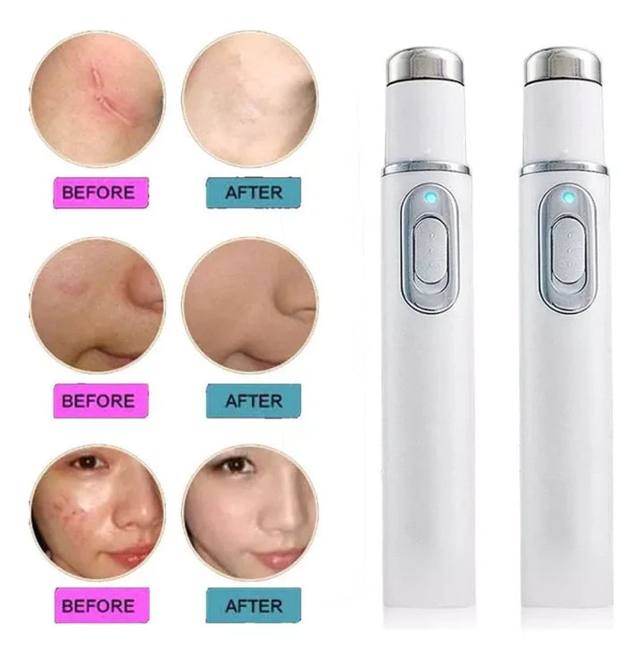 Lasér Removedor de Acne